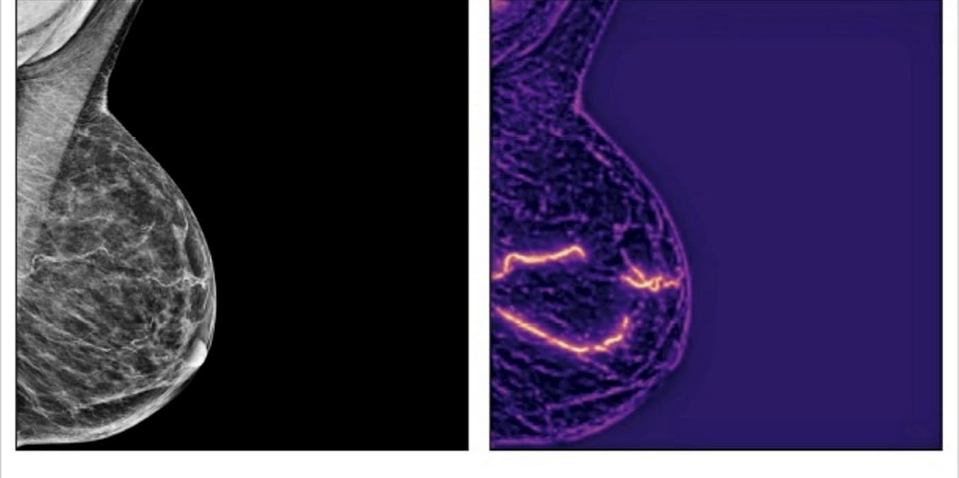 KI-Revolution in der Mammographie: Brustkrebs-Vorsorge erkennt jetzt auch Herzinfarkt-Risiko